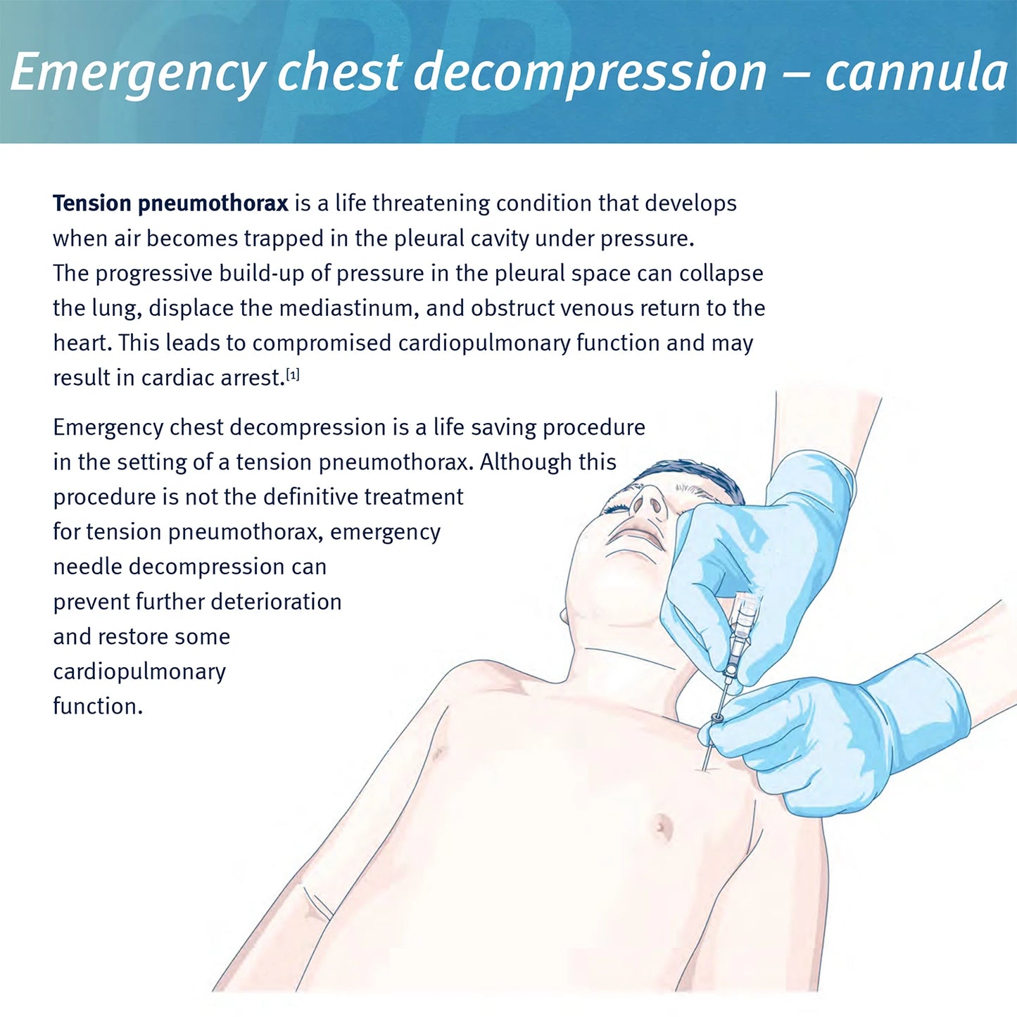Sanke Emergency Pneumothorax Decompression Needle for Trauma First Aid Kit